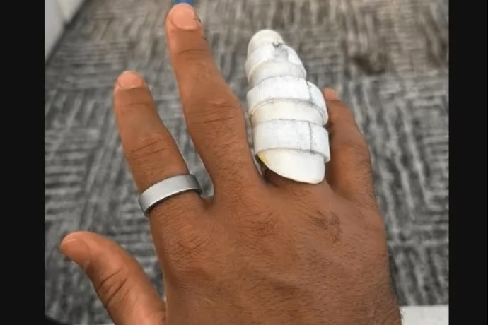 哈特晒术后无名指护具照，湖人后卫线恢复进程引关注